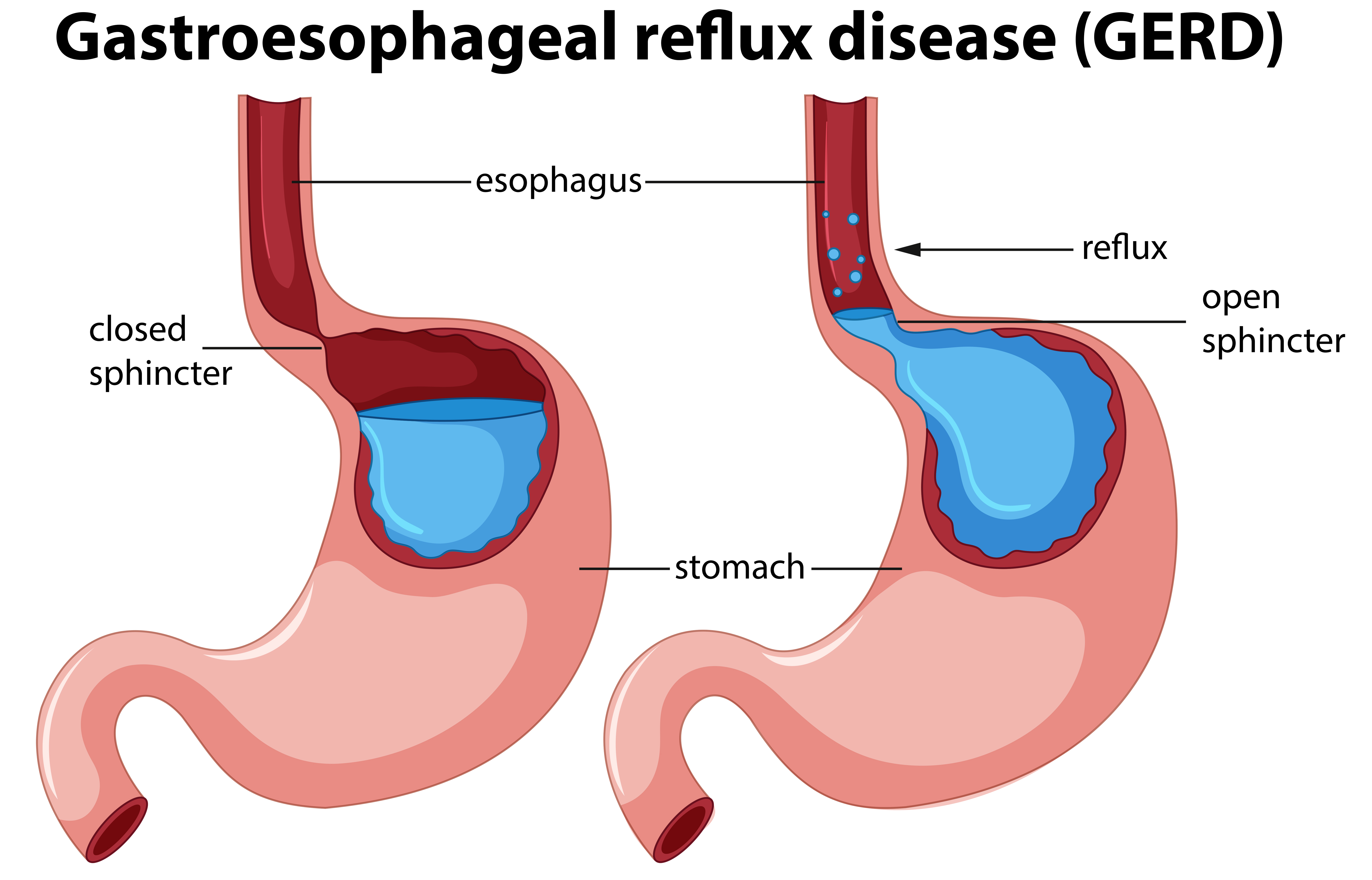 Gastroesophageal Reflux Disease (GERD) Diagram